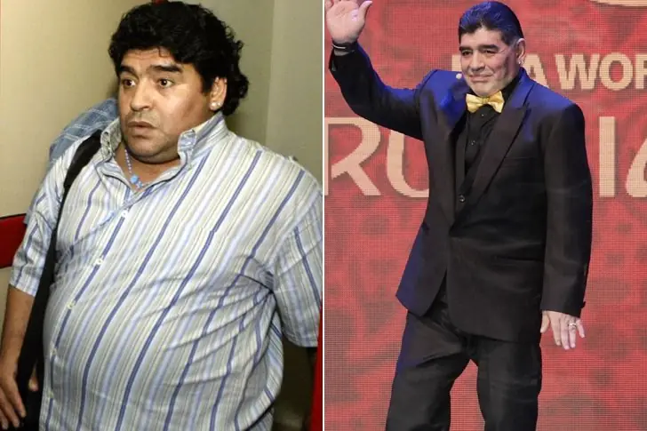 Diego Maradona – 75 Lbs – Gastric Bypass Surgery